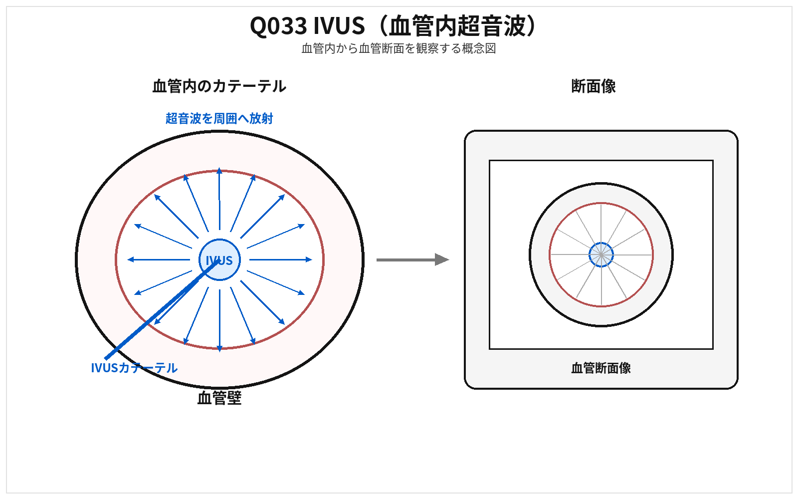 第46回AM 問題33の解説用図表: IVUS