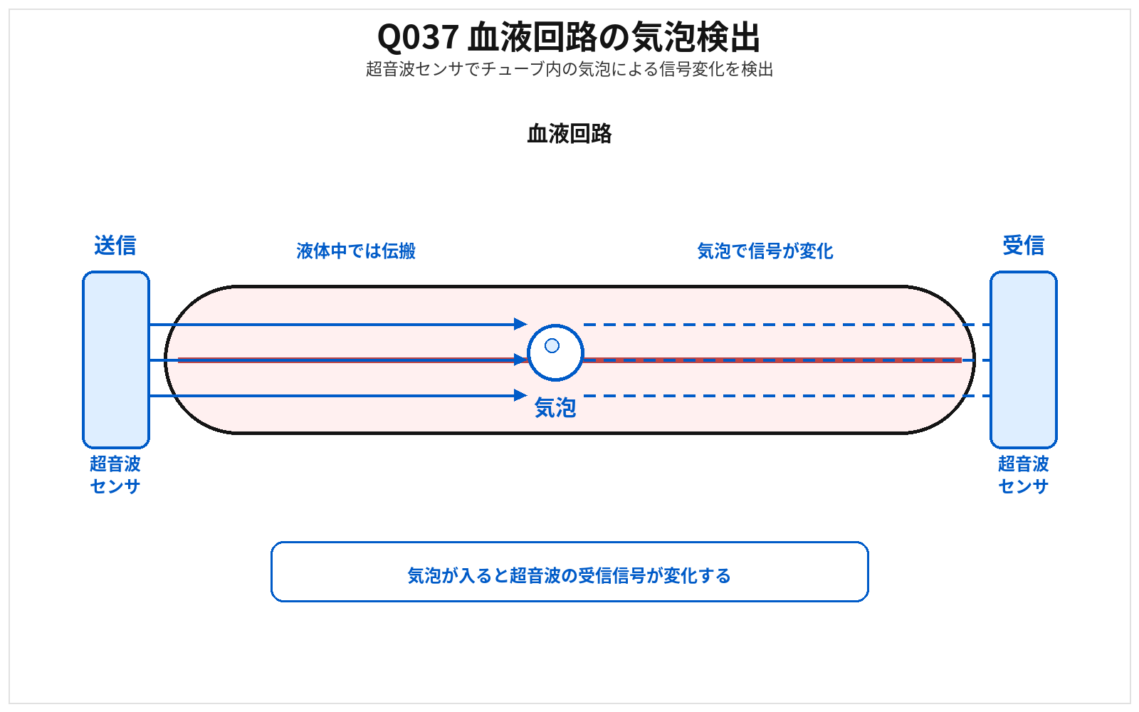 第46回AM 問題37の解説用図表: 気泡検出