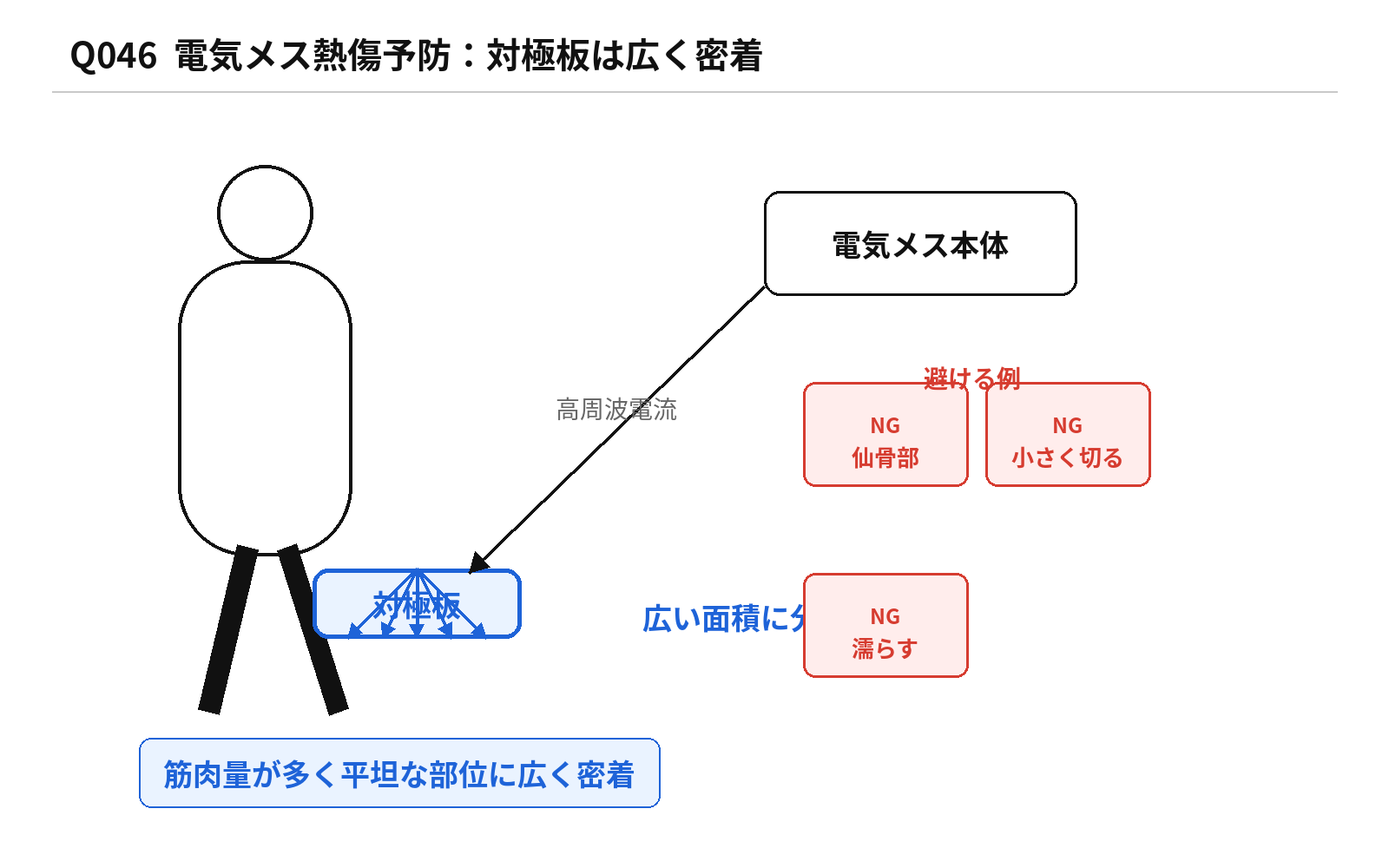 第46回PM 問題46の解説用図表: 電気メス対極板と熱傷予防